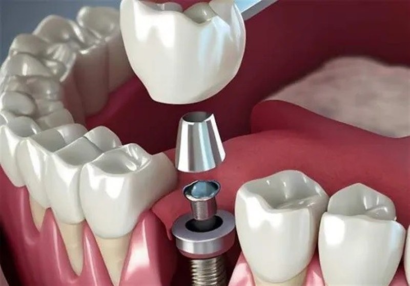  تبلیغ ایمپلنت فوری دروغ است/سلبریتی‌ها حق تبلیغ خدمات پزشکی را ندارند