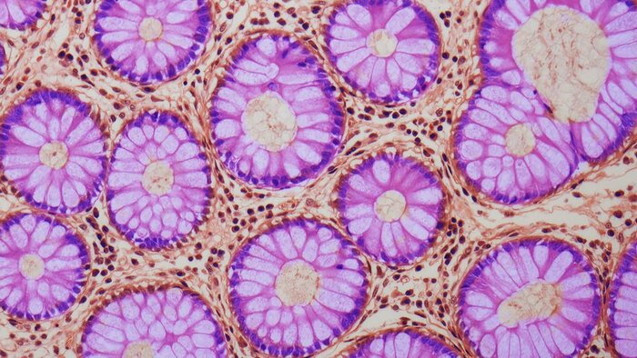 چگونه التهاب و کمبود آهن رانش پیری در روده را تسریع می‌کند